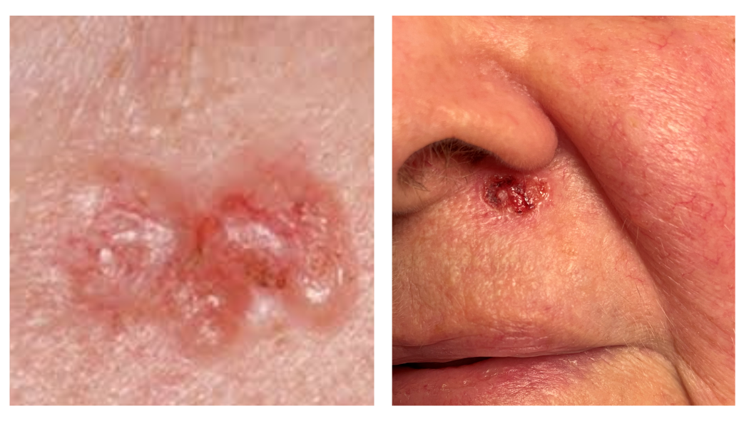 Basal cell carcinoma examples