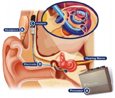 Diagram of a Cochlear Implant device