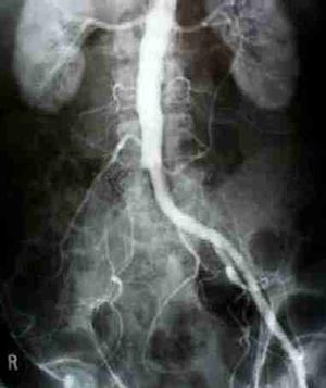 Image of an abdominal angiogram