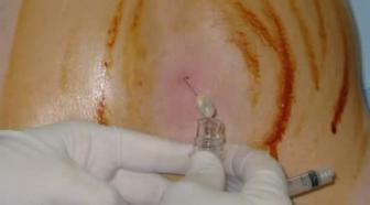 Image of a lumbar puncture after disinfection with iodine solution