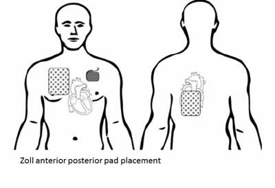 defibrillation placement pads pad defibrillator position directive medical lhsc pacemaker safety