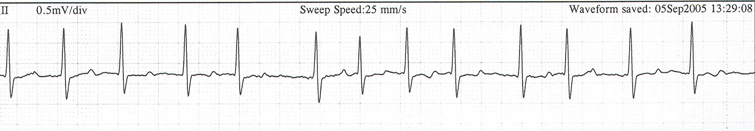 Atrial Fibrillation