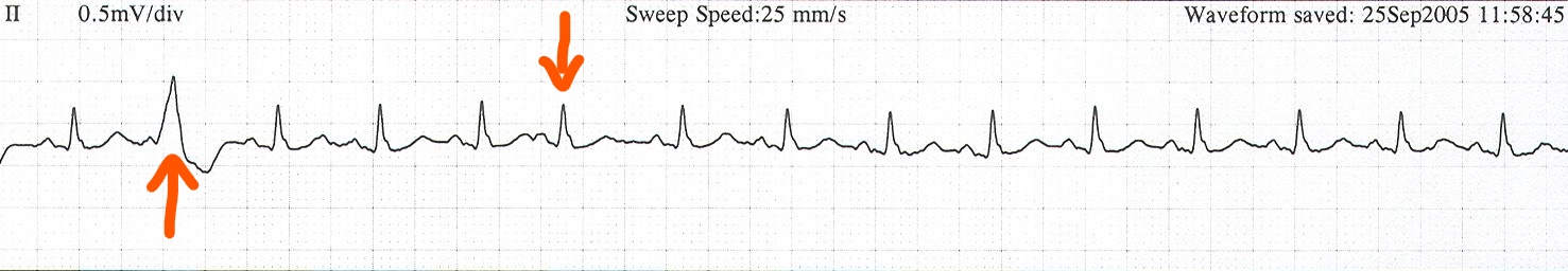 Normal rhythm with "different" or "early" beats