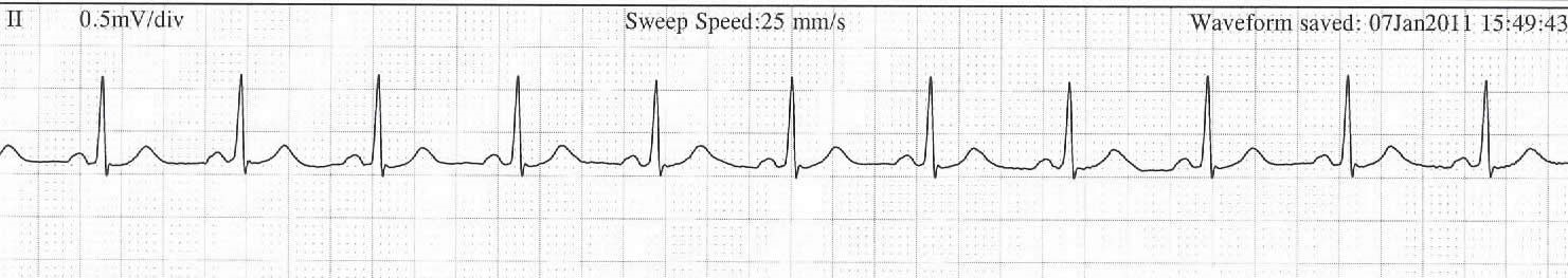 Normal Sinus Rhythm