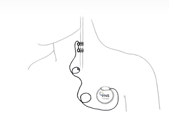 VNS2