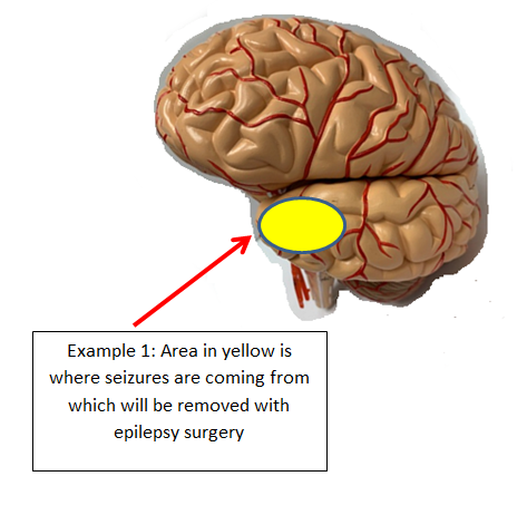 Focal resection 1