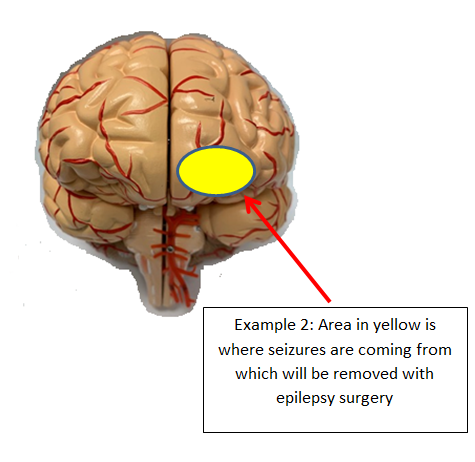 Focal resection 2