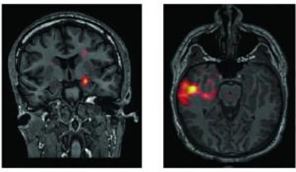 Inter-Ictal SPECT scans occur between seizures