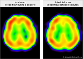 Ictal SPECT scans occur during the epileptic seizure