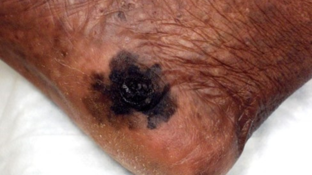 Melanoma example