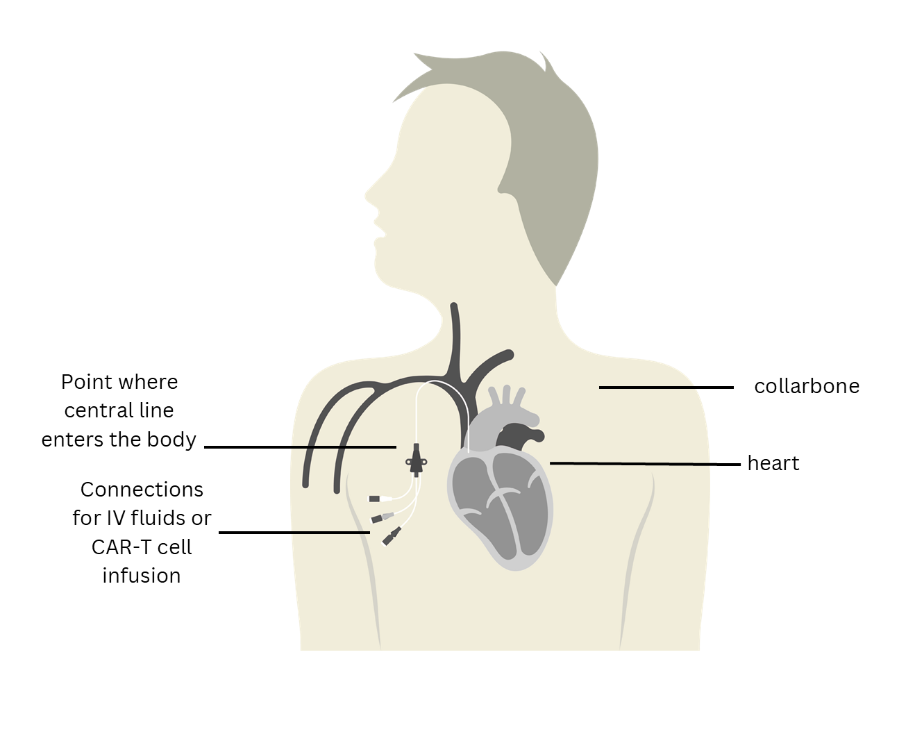 Illustration of a person’s upper torso showing the placement of a central line above the chest, with labels pointing to the entry site, IV connections, the collarbone, and the heart.