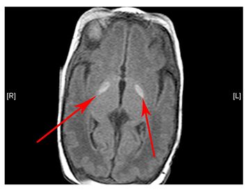 A brain under MRI showing abnormal basal ganglia