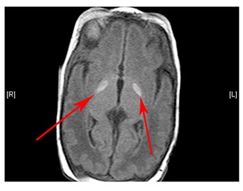 A brain under MRI showing abnormal basal ganglia