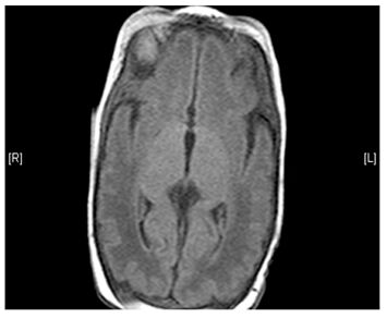 An MRI of a healthy brain