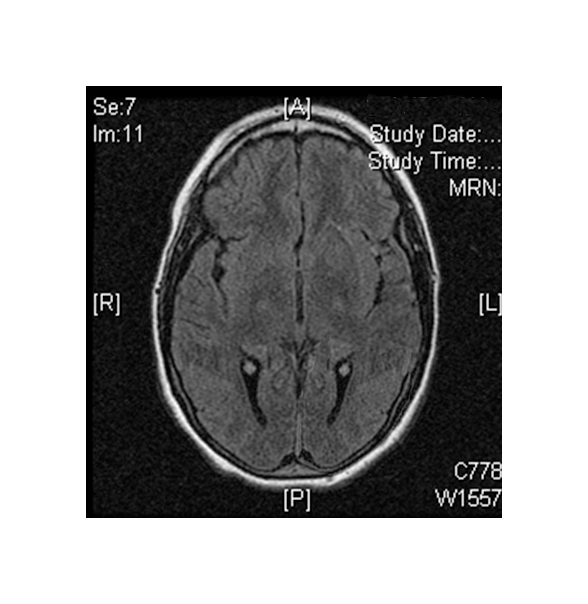 An MRI of a healthy brain