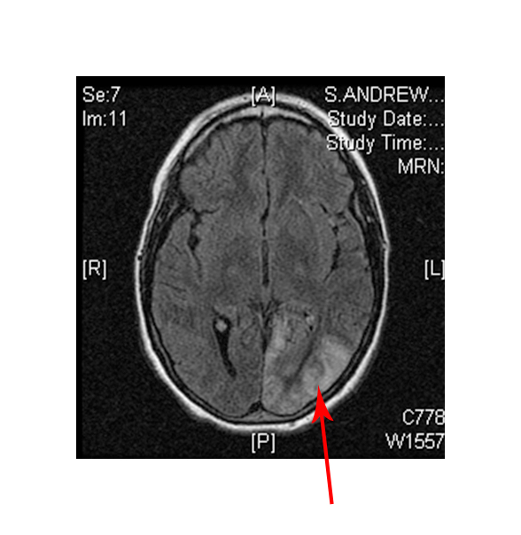 An MRI showing signs of a stroke.