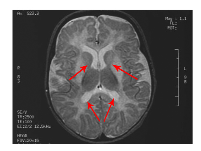 An MRI scan of a brain shows abnormalities in the signals and putamen
