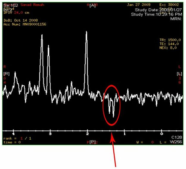 MRS image showing tell-tale W that is a sign for high lactate concentration