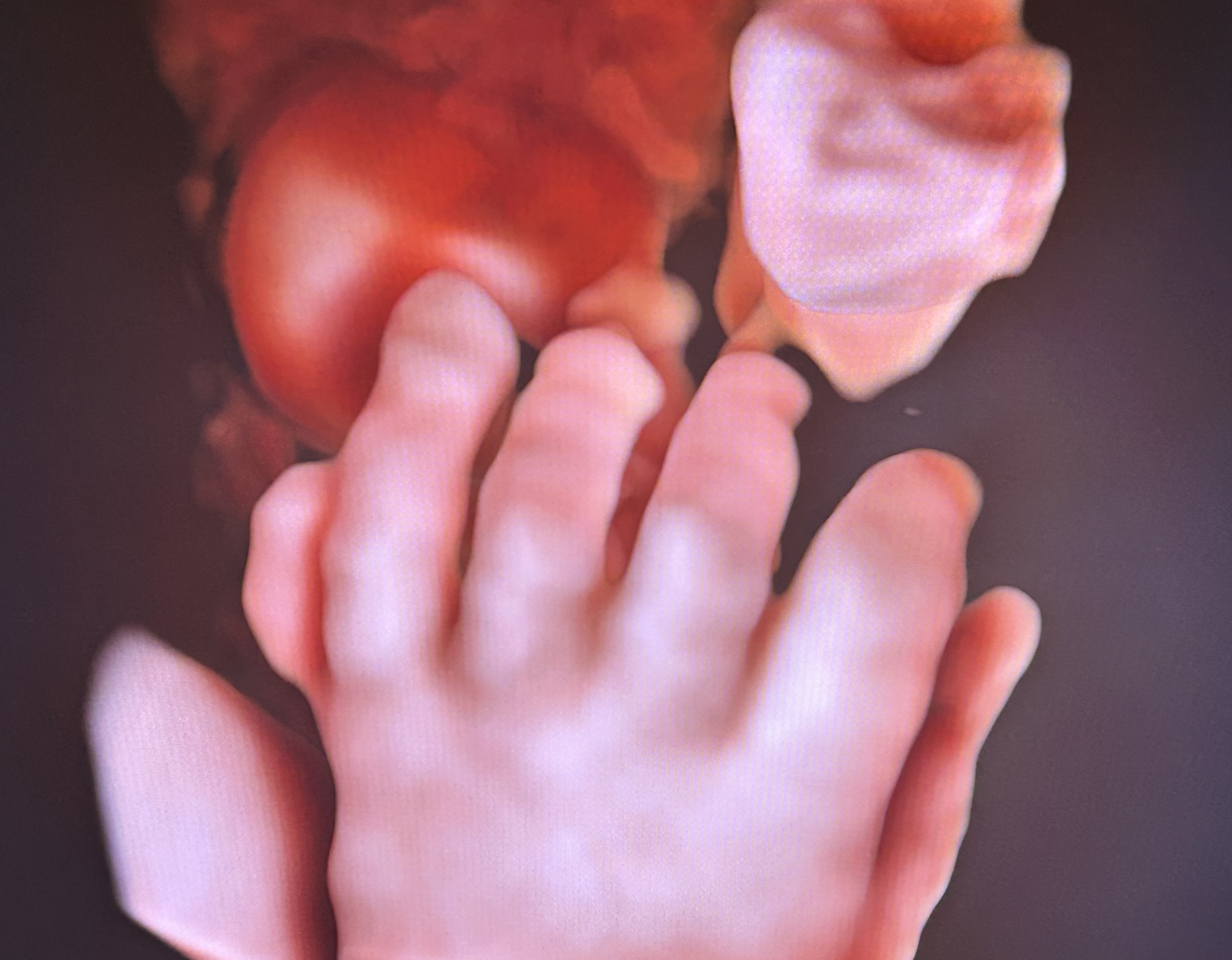 4D maternal ultrasound picture from the Voluson™ Expert 22 ultrasound machine