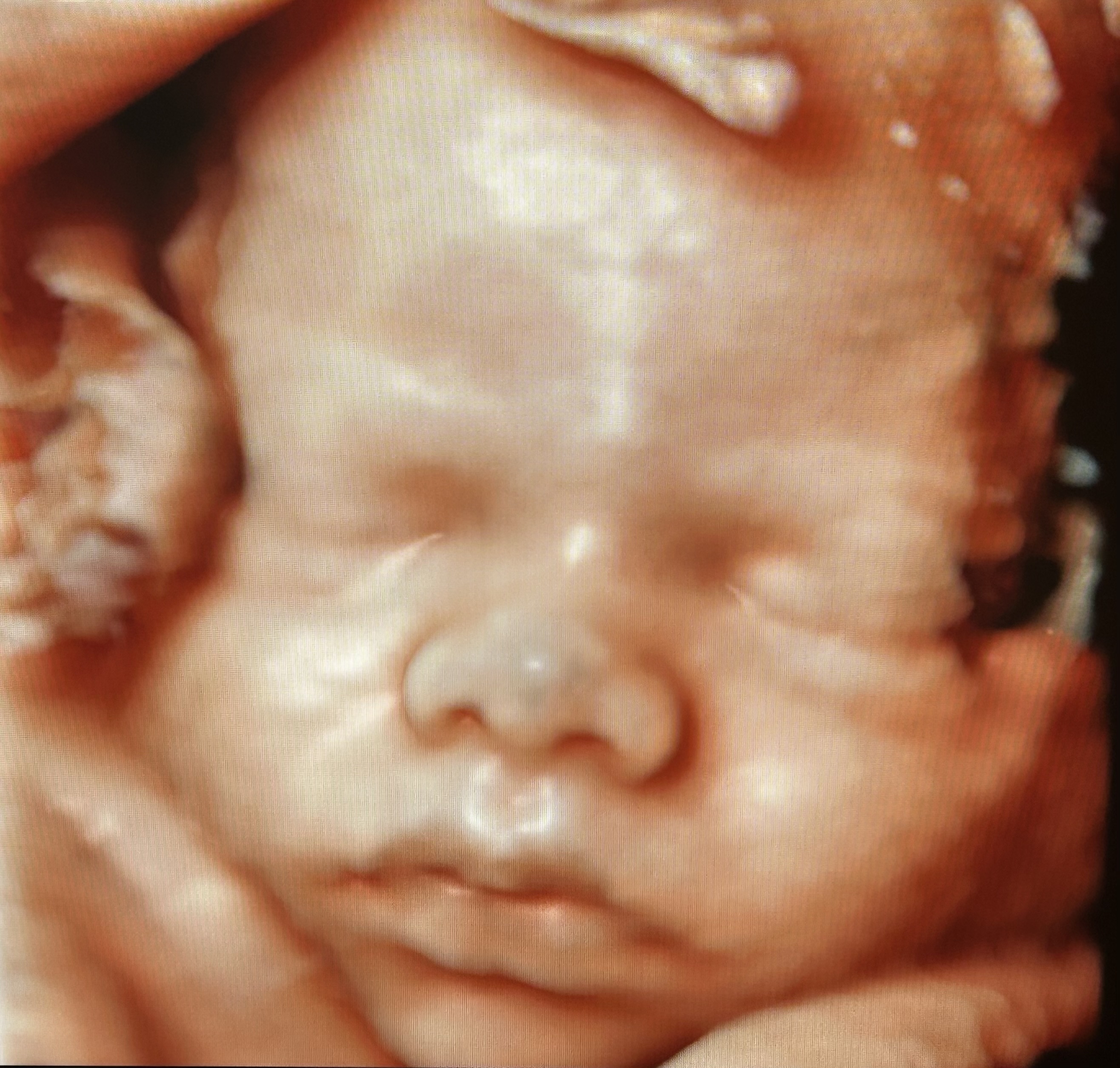 4D maternal ultrasound picture from the Voluson™ Expert 22 ultrasound machine