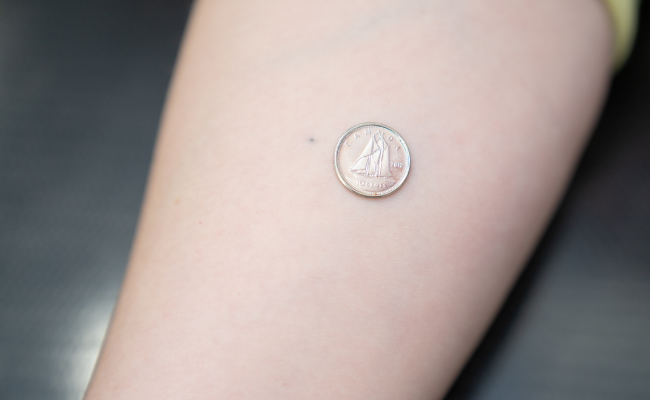 Small dot tattoo on the forearm of a patient with a dime placed beside the tattoo for comparison. 