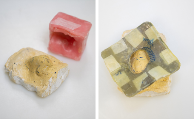 Two photos showing a nose mould used by the radiation therapy team to help keep the treatment area still.