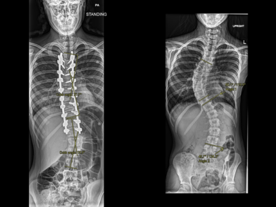 A set of X-rays showing Paige Hillman's spine before and after her scoliosis correction using the Mazor Robotic System.