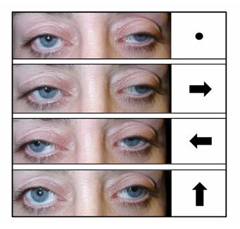 external ophthalmoplegia diagram showing the resulting droopy eyes