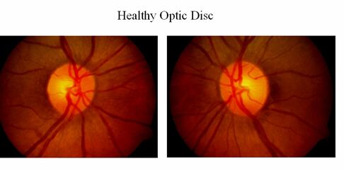Healthy optical disc in eyes