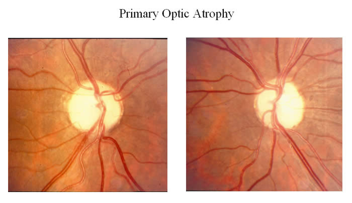 A set of optical discs afflicted with primary optic atrophy