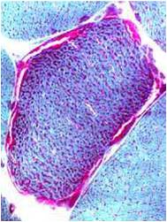 A microscope image of a cell showing signs of ragged red fibres