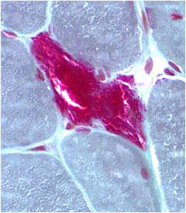 A microscope image of a cell showing signs of ragged red fibres