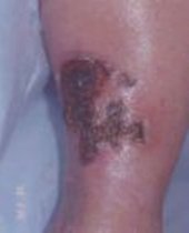 Arterial Ulcer