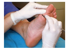Debridement