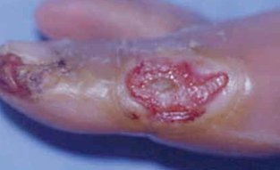 diabetic/neuropathic ulcer