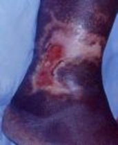 Venous Ulcer