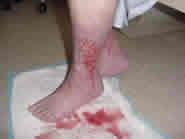 cellulitis