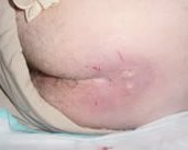 sacral ulcer