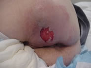 clean wound with granulating tissue