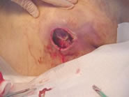 deep wound with tunneling / stage 4