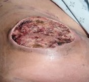 Wet wound with granulating tissue, yellow slough, and some black eschar (not infected) 