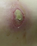 hip wound with yellow slough / stage X