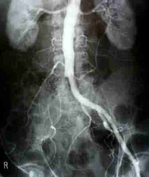 Angiogram