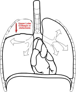 Atelectasis