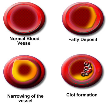 Narrowing of a blood vessel
