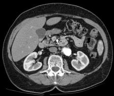 CT Abdomen