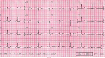 ECG