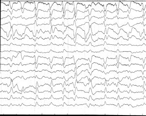 EEG