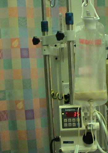 Enteral Feeding