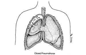 Pneumothorax